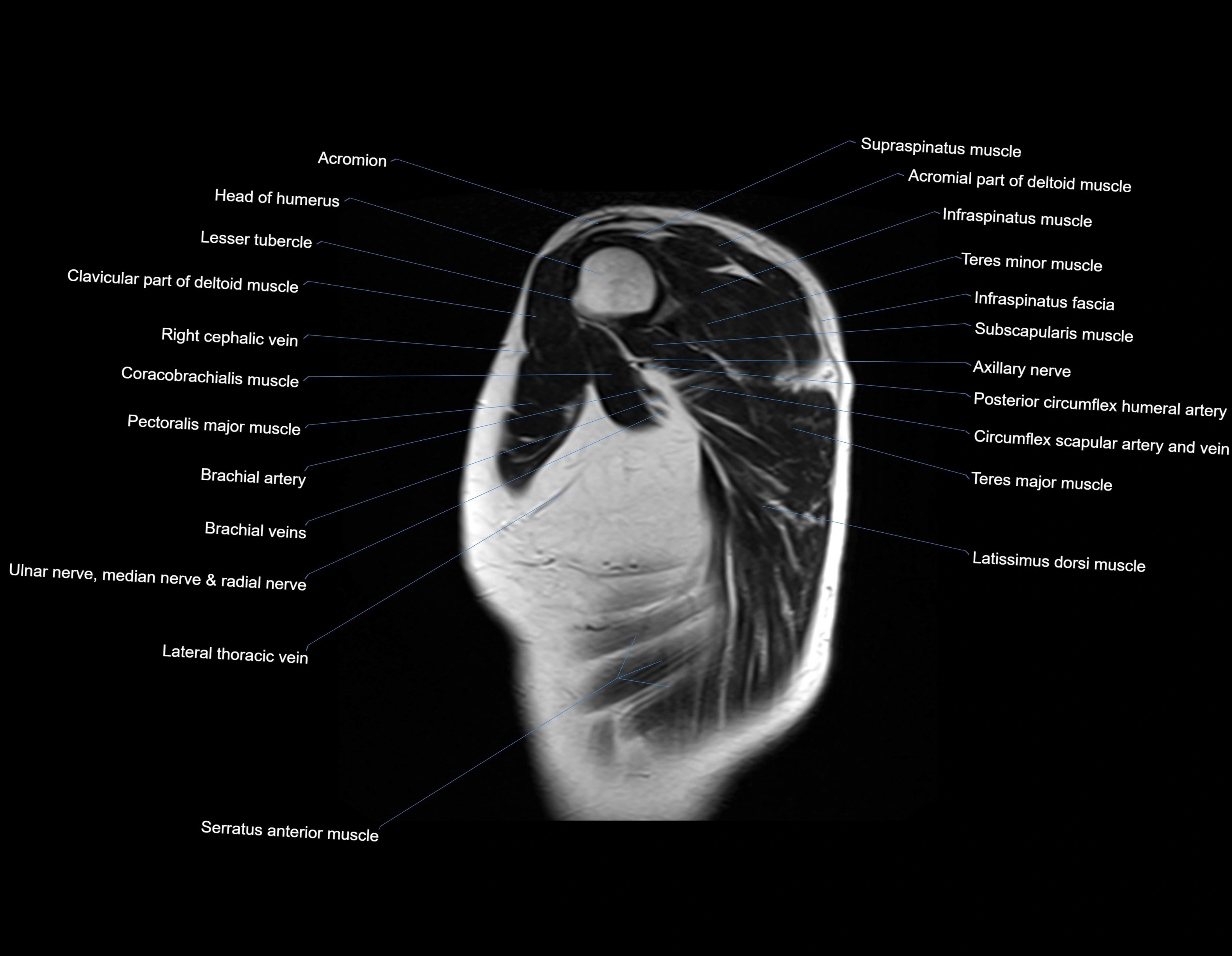 MRI chest (thorax) sagittal labelled cross sectional anatomy 3T radiology image-img-00001-00002.webp